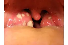 Bebeklerde Boğaz Enfeksiyonuna Ne İyi Gelir? Bebeklerde Boğaz Enfeksiyonuna Ne İyi Gelir?