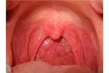 Boğaz Enfeksiyonuna Ne İyi Gelir?