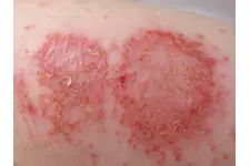 Vücutta Enfeksiyon Belirtileri ve Tedavisi Vücutta Enfeksiyon Belirtileri ve Tedavisi