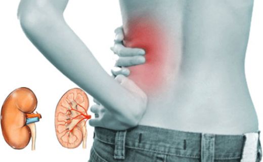 Böbrek Enfeksiyonu Belirtileri ve Tedavisi