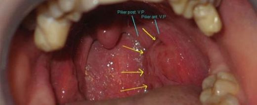 Boğaz Enfeksiyonu Bitkisel Tedavi Yöntemleri