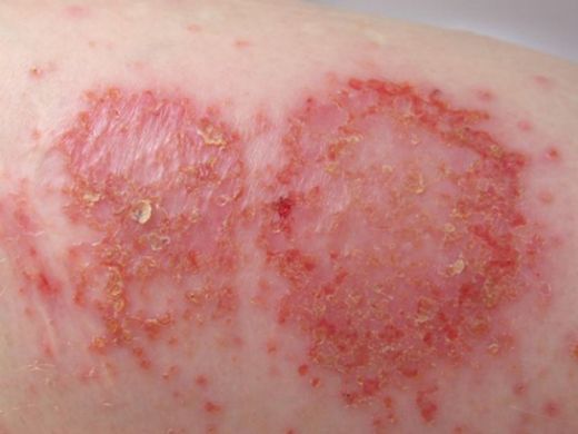 Enfeksiyon Çeşitleri Nelerdir?