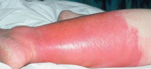 Selülit Enfeksiyonu Belirtileri ve Tedavisi