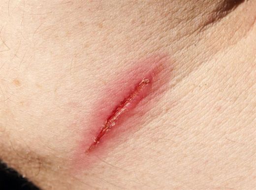 Yara Enfeksiyonu Belirtileri ve Tedavisi